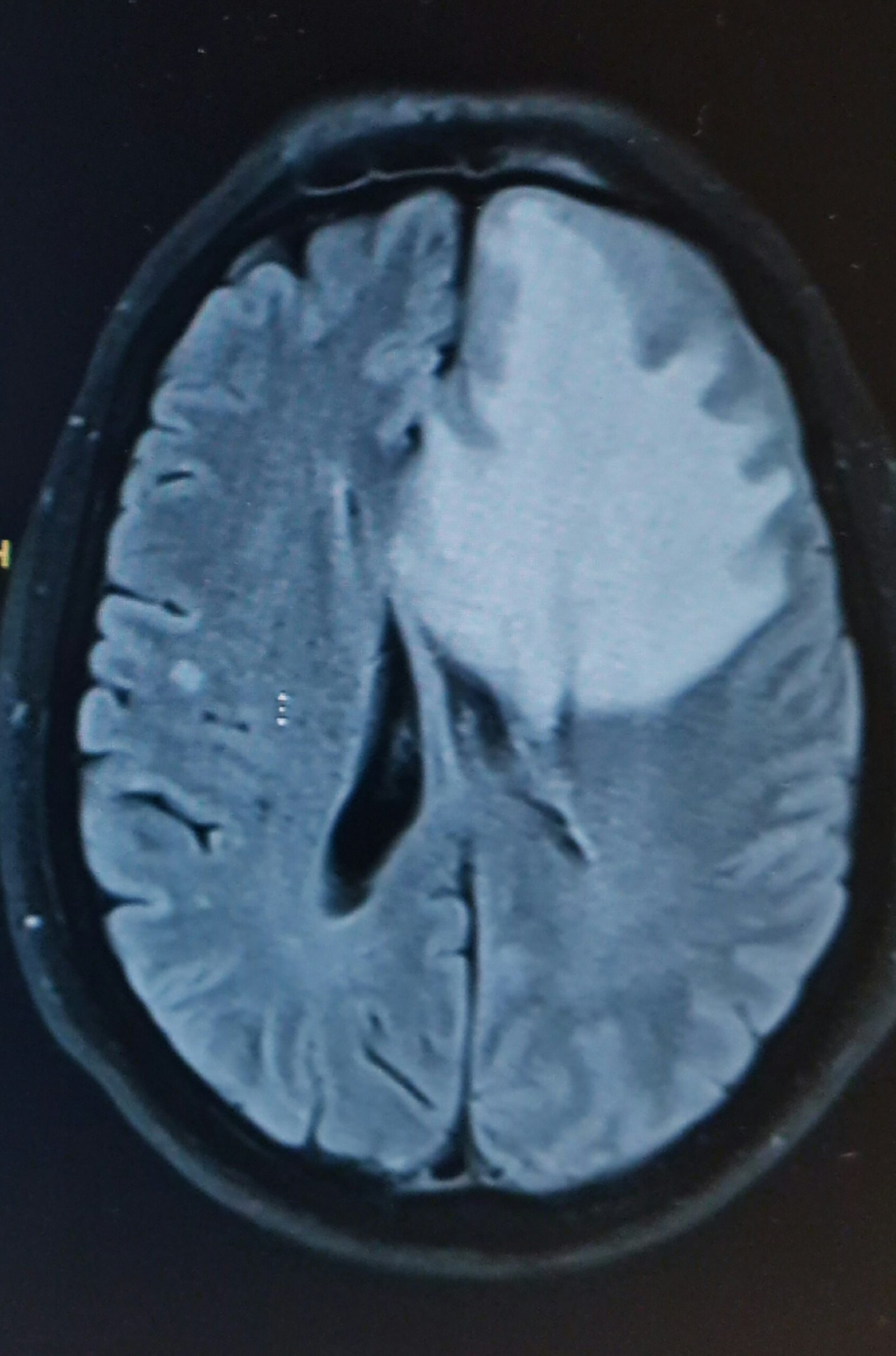 RM Cerebral