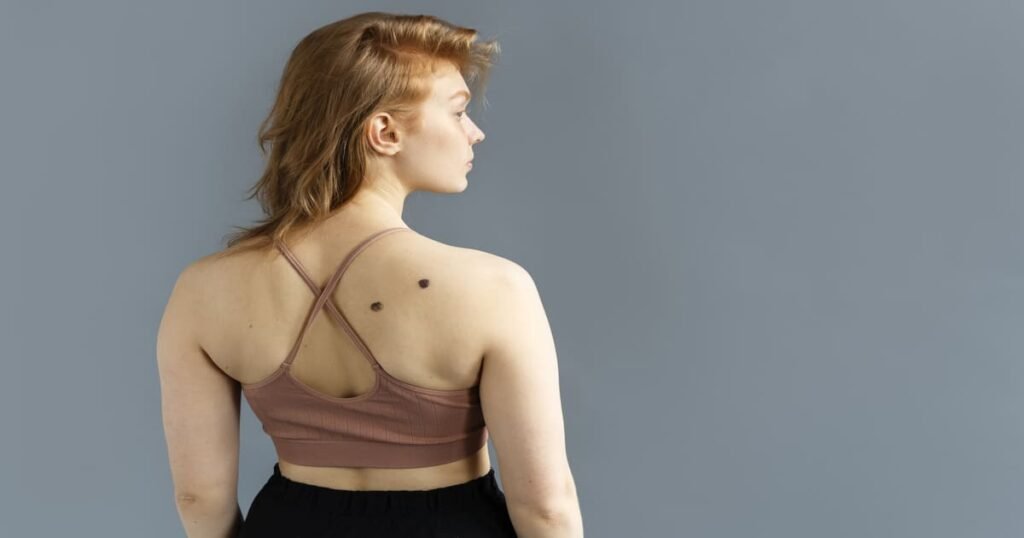 Melanoma